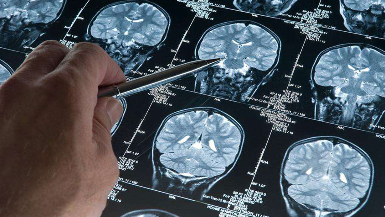Alzheimer hastalığını erken evrede tespit edebilen kan testi geliştirildi