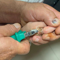 Çocuğun parmağına sıkışan metal cisim, kesilerek çıkarıldı