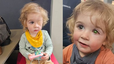 2 yaşındaki çocuk bir öpücük yüzünden kör oldu!