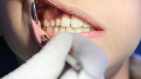 Diş çürüğü ve diş eti sorunu olanlar dikkat: O hastalığı tetikliyor