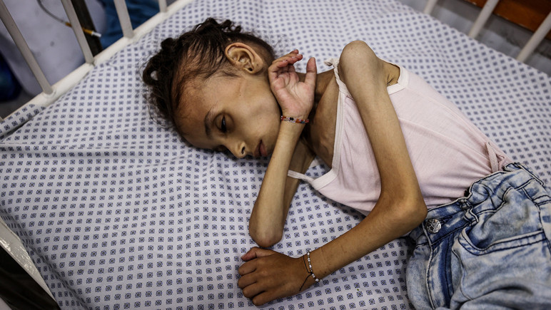 9 -Year -old Mary en Gaza cayó de 25 libras a 10 kilos -Imagen: 2