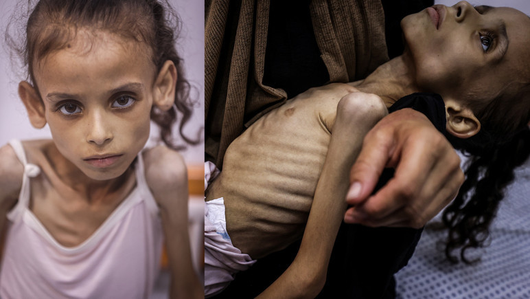 9 -Year -old Mary en Gaza cayó de 25 libras a 10 kilos -Imagen: 1