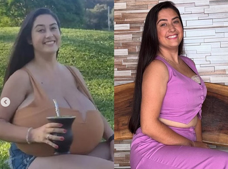 Sadece 300 kişide görülen hastalık: Göğüsleri aylar içinde 12 kiloya ulaştı - Resim : 1