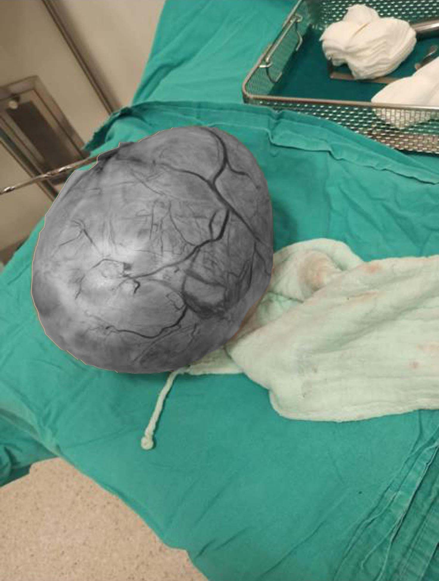 Zayıflamak isteyen kadının karnından çıkan doktoru şoke etti: Tam 7 kilo 390 gram! - Resim: 6