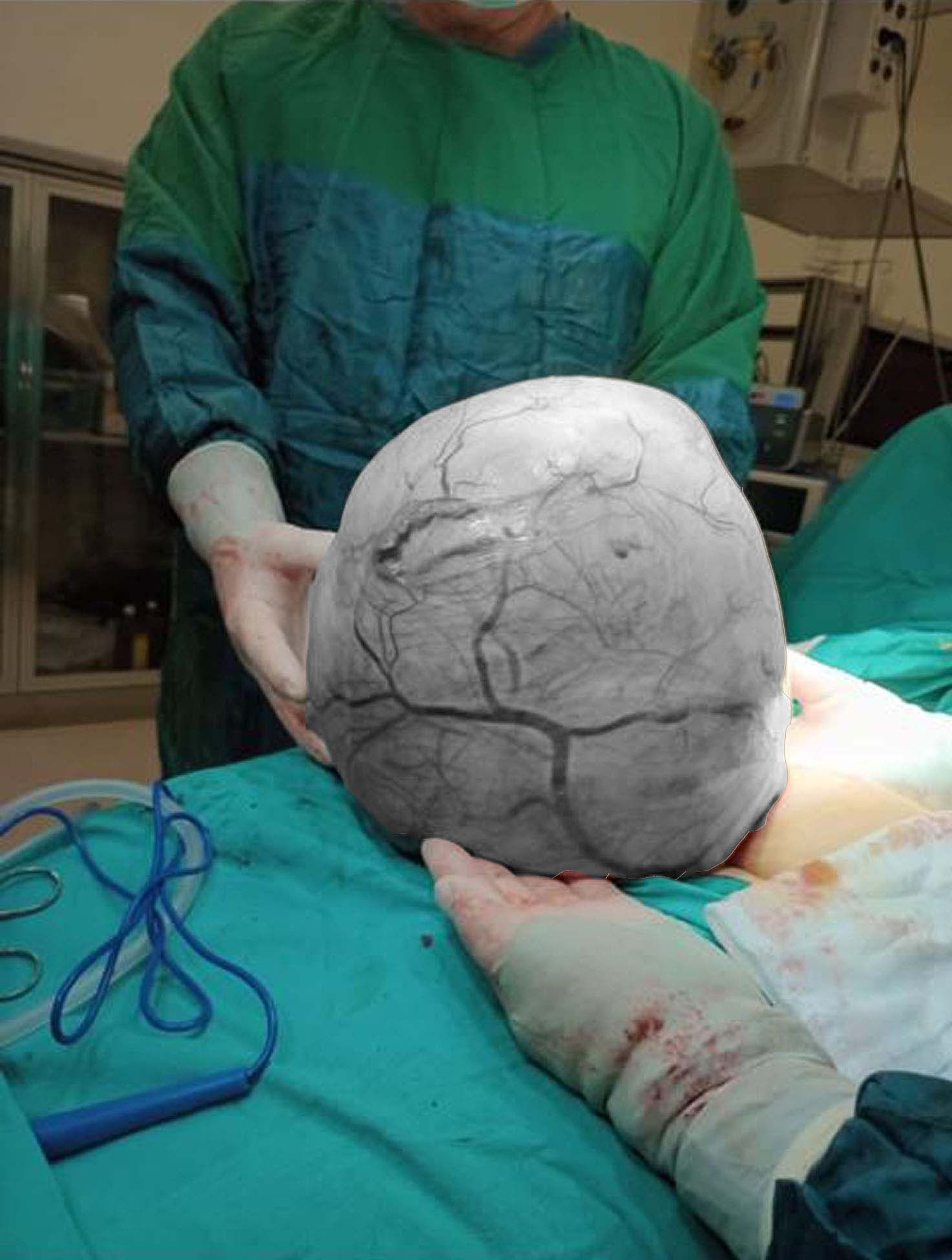 Zayıflamak isteyen kadının karnından çıkan doktoru şoke etti: Tam 7 kilo 390 gram! - Resim: 5